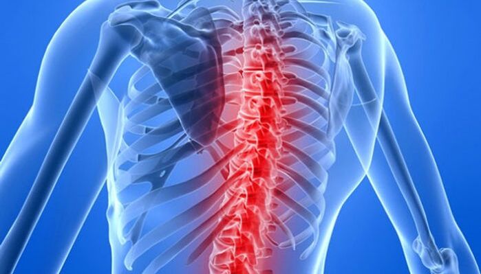 Wirbelsäulenpathologien sind die häufigste Ursache für Rückenschmerzen im Schulterblattbereich