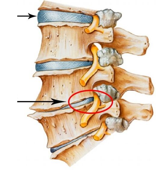 zervikale Osteochondrose