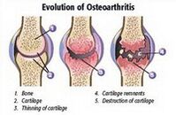 Osteoarthritis -Phase