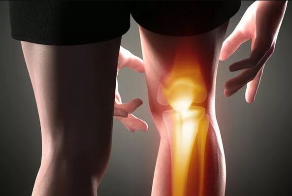 Arthrose des Kniegelenks