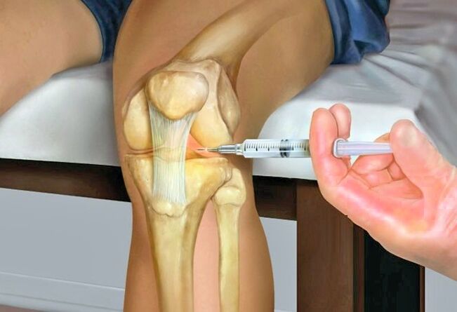 Behandlung der Arthrose des Kniegelenks