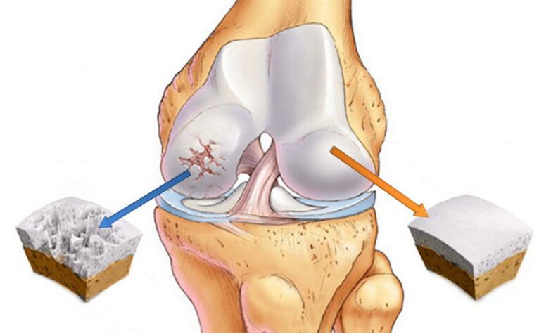 Arthrose verformen