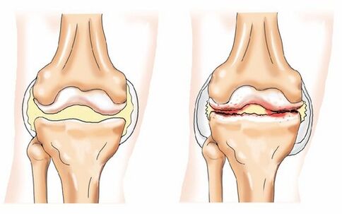 Gesunde und Arthrosis Gelenk