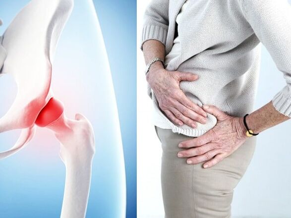 Symptome der Arthrose des Hüftgelenks