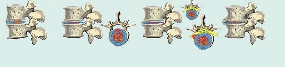 verschiedene Stadien der thorakalen Osteochondrose