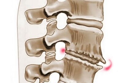 Schädigung der Wirbel bei thorakaler Osteochondrose
