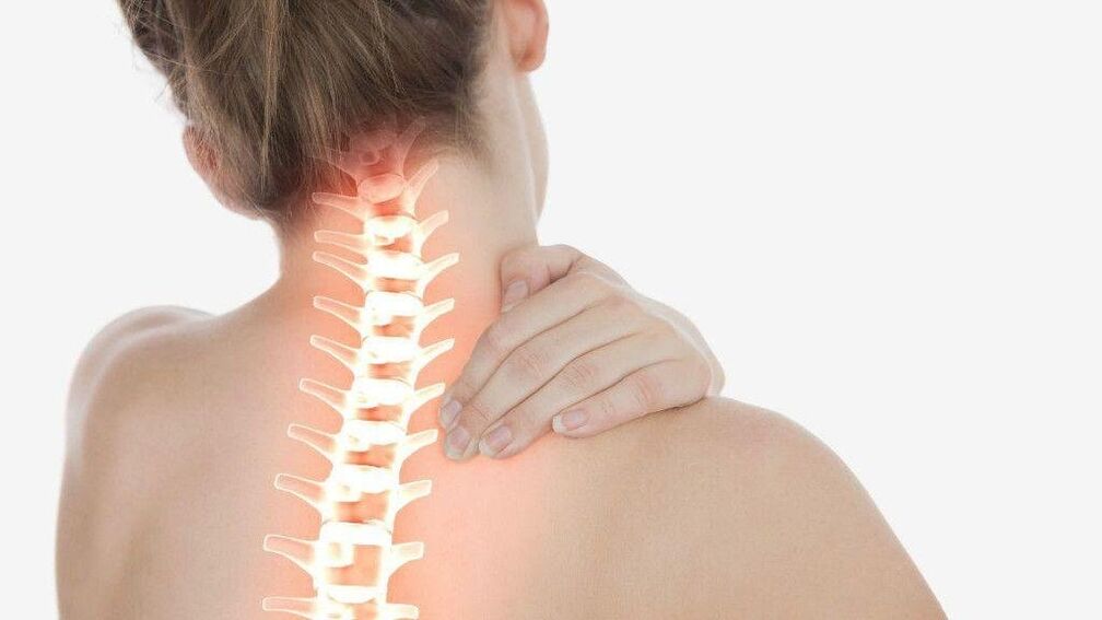 Bei einer Osteochondrose der Halswirbelsäule kann sich ein radikuläres Syndrom entwickeln